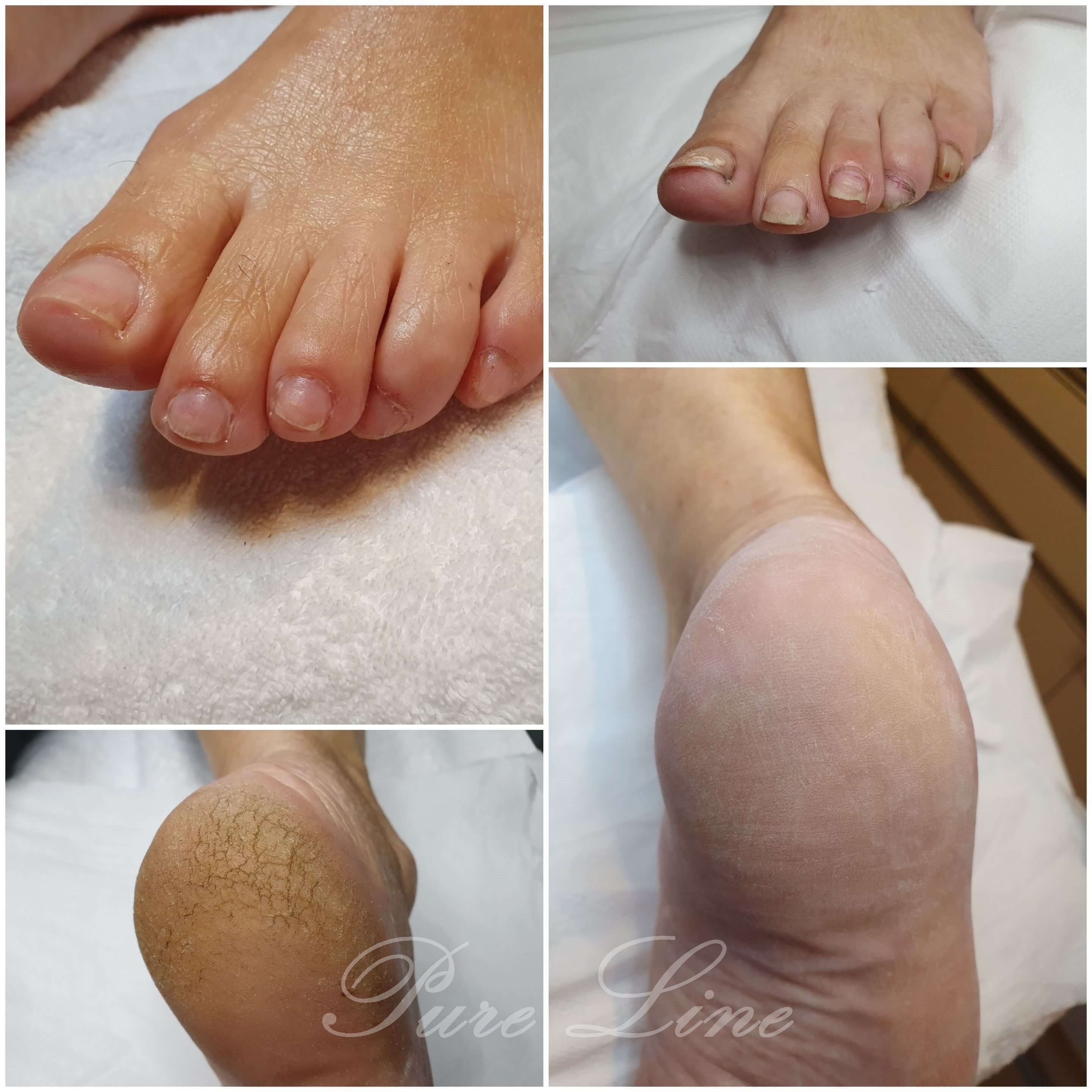 Zabiegi pedicure podologiczny